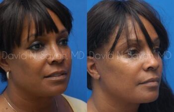 Facelift Before and After | Sayah Institute