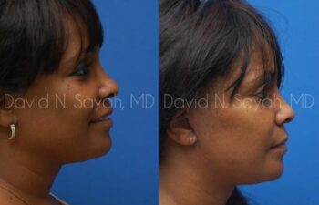 Facelift Before and After | Sayah Institute