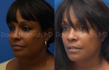Facelift Before and After | Sayah Institute