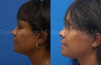 Facelift Before and After | Sayah Institute