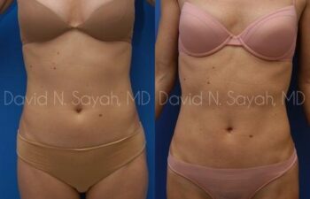 Liposuction Before and After | Sayah Institute