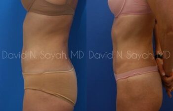 Liposuction Before and After | Sayah Institute