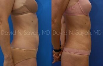 Liposuction Before and After | Sayah Institute