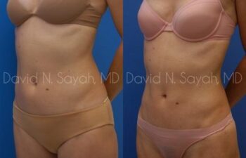 Liposuction Before and After | Sayah Institute