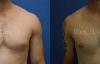 Male Breast Surgery Before and After | Sayah Institute