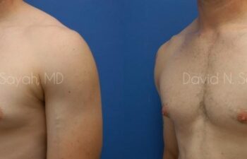 Male Breast Surgery Before and After | Sayah Institute