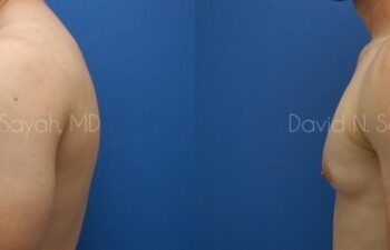Male Breast Surgery Before and After | Sayah Institute