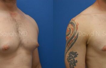 Male Breast Surgery Before and After | Sayah Institute