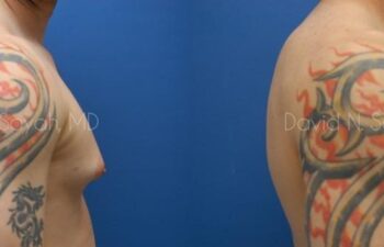 Male Breast Surgery Before and After | Sayah Institute