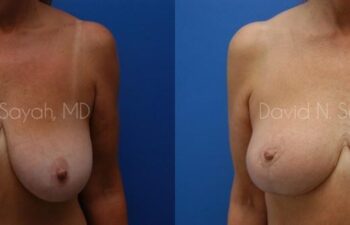 Mommy Makeover Before and After | Sayah Institute