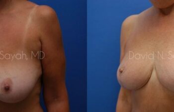 Mommy Makeover Before and After | Sayah Institute