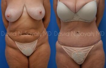 Mommy Makeover Before and After | Sayah Institute