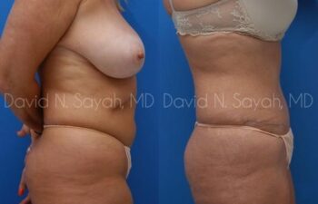 Mommy Makeover Before and After | Sayah Institute