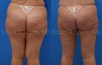 Mommy Makeover Before and After | Sayah Institute
