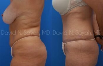 Mommy Makeover Before and After | Sayah Institute