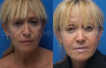 Neck Lift Before and After | Sayah Institute