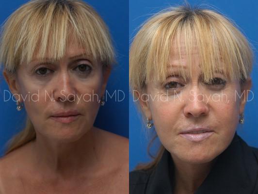 Neck Lift Before and After | Sayah Institute