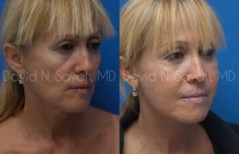 Neck Lift Before and After | Sayah Institute