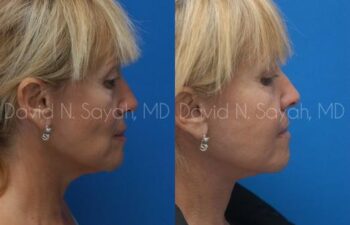 Neck Lift Before and After | Sayah Institute