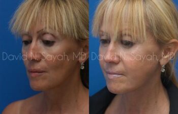 Neck Lift Before and After | Sayah Institute