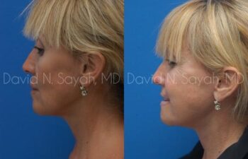 Neck Lift Before and After | Sayah Institute