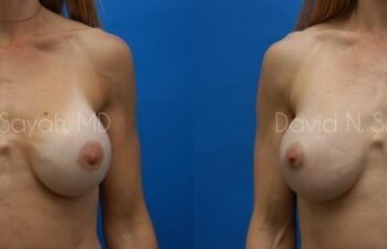 Breast Augmentation And Mastopexy Before and After | Sayah Institute