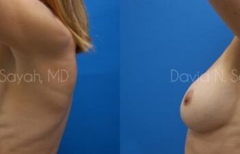 Breast Augmentation And Mastopexy Before and After | Sayah Institute