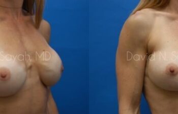Breast Augmentation And Mastopexy Before and After | Sayah Institute