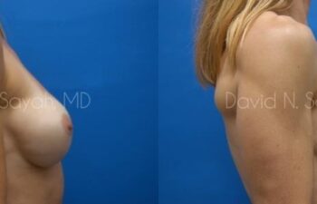 Breast Augmentation And Mastopexy Before and After | Sayah Institute