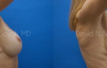 Breast Augmentation And Mastopexy Before and After | Sayah Institute