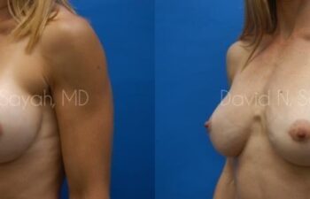 Breast Augmentation And Mastopexy Before and After | Sayah Institute