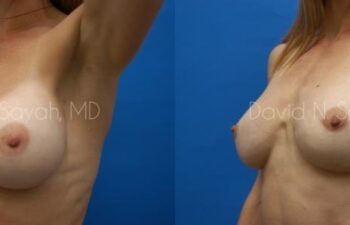 Breast Augmentation And Mastopexy Before and After | Sayah Institute
