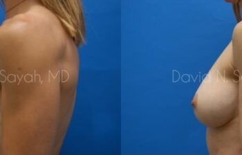 Breast Augmentation And Mastopexy Before and After | Sayah Institute