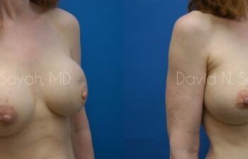 Breast Augmentation And Mastopexy Before and After | Sayah Institute