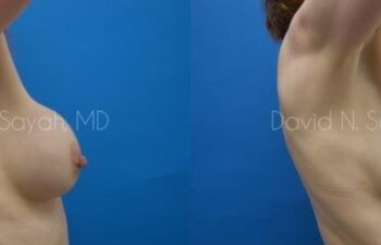 Breast Augmentation And Mastopexy Before and After | Sayah Institute