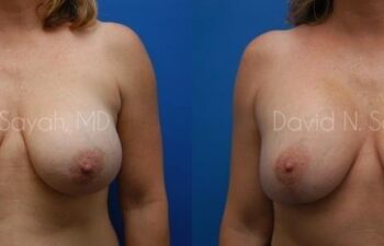 Breast Augmentation And Mastopexy Before and After | Sayah Institute