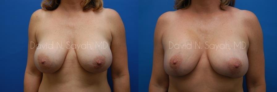 Breast Augmentation And Mastopexy Before and After | Sayah Institute