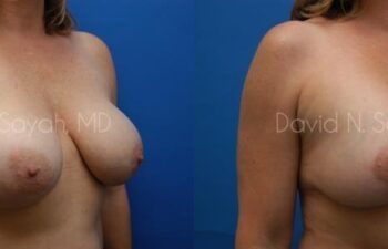 Breast Augmentation And Mastopexy Before and After | Sayah Institute