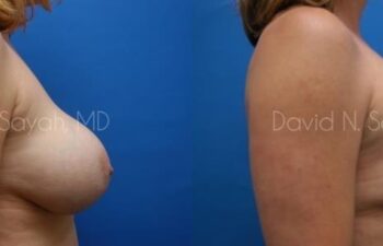 Breast Augmentation And Mastopexy Before and After | Sayah Institute
