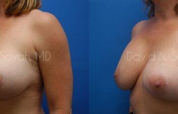 Breast Augmentation And Mastopexy Before and After | Sayah Institute