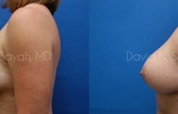 Breast Augmentation And Mastopexy Before and After | Sayah Institute