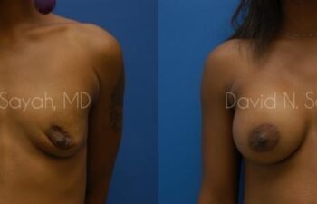 Breast Augmentation Before and After | Sayah Institute