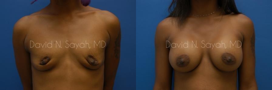 Breast Augmentation Before and After | Sayah Institute