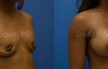 Breast Augmentation Before and After | Sayah Institute