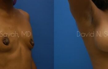 Breast Augmentation Before and After | Sayah Institute