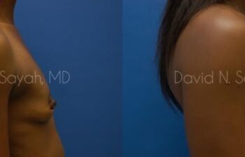 Breast Augmentation Before and After | Sayah Institute