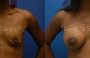 Breast Augmentation Before and After | Sayah Institute
