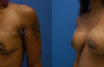 Breast Augmentation Before and After | Sayah Institute