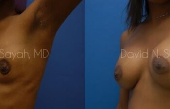 Breast Augmentation Before and After | Sayah Institute