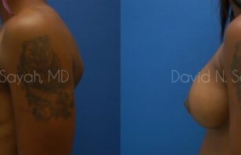 Breast Augmentation Before and After | Sayah Institute